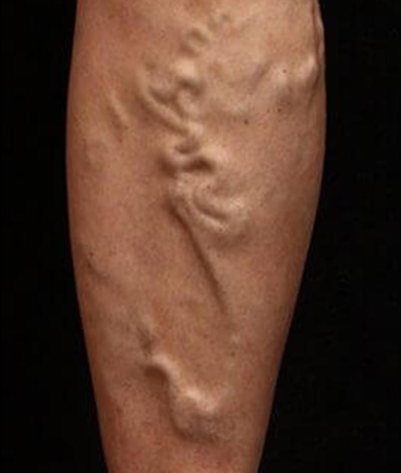 Varicose Veins Before & After Gallery - Patient 37499825 - Image 1