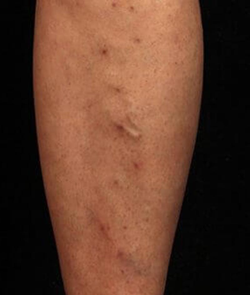 Varicose Veins Before & After Gallery - Patient 37499825 - Image 2
