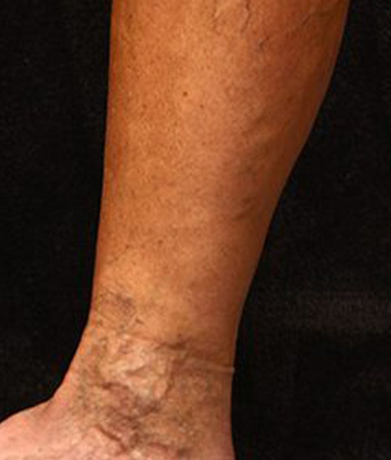 Varicose Veins Before & After Gallery - Patient 37499827 - Image 1