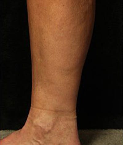 Varicose Veins Before & After Gallery - Patient 37499827 - Image 2