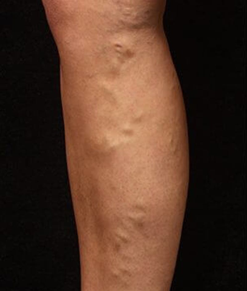Varicose Veins Before & After Gallery - Patient 37499829 - Image 1