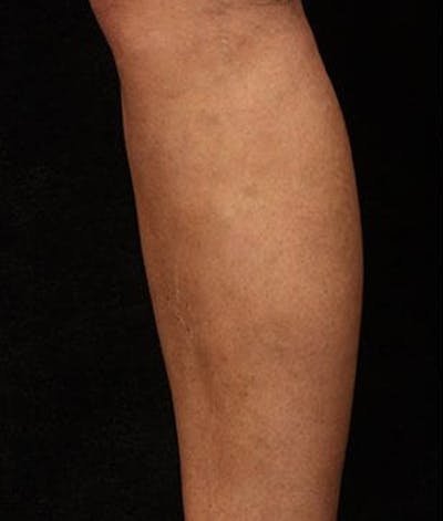 Varicose Veins Before & After Gallery - Patient 37499829 - Image 2