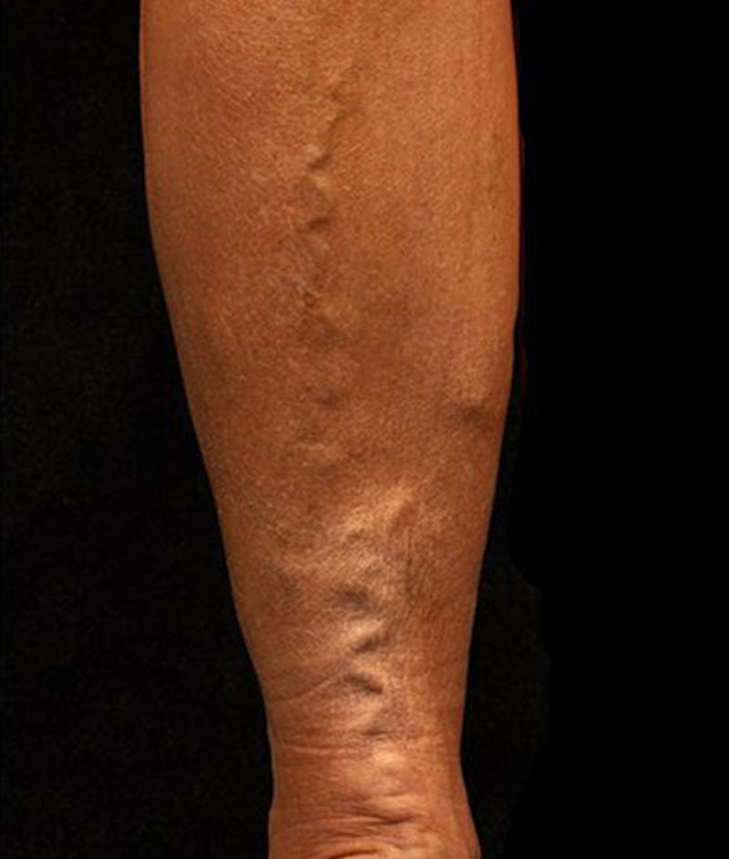 Varicose Veins Before & After Gallery - Patient 37499831 - Image 1