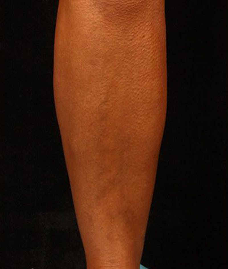 Varicose Veins Before & After Gallery - Patient 37499831 - Image 2