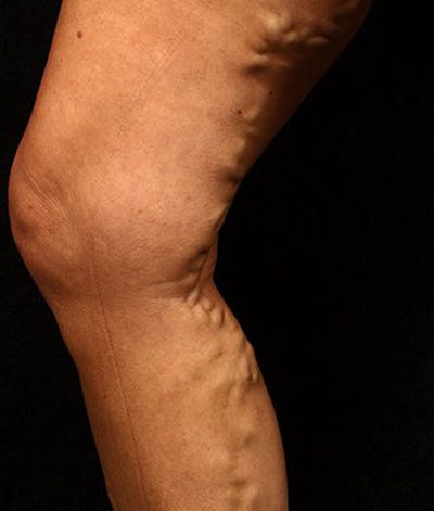 Varicose Veins Before & After Gallery - Patient 37499833 - Image 1