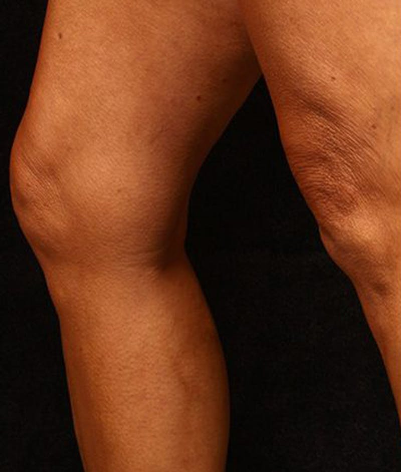 Varicose Veins Before & After Gallery - Patient 37499833 - Image 2