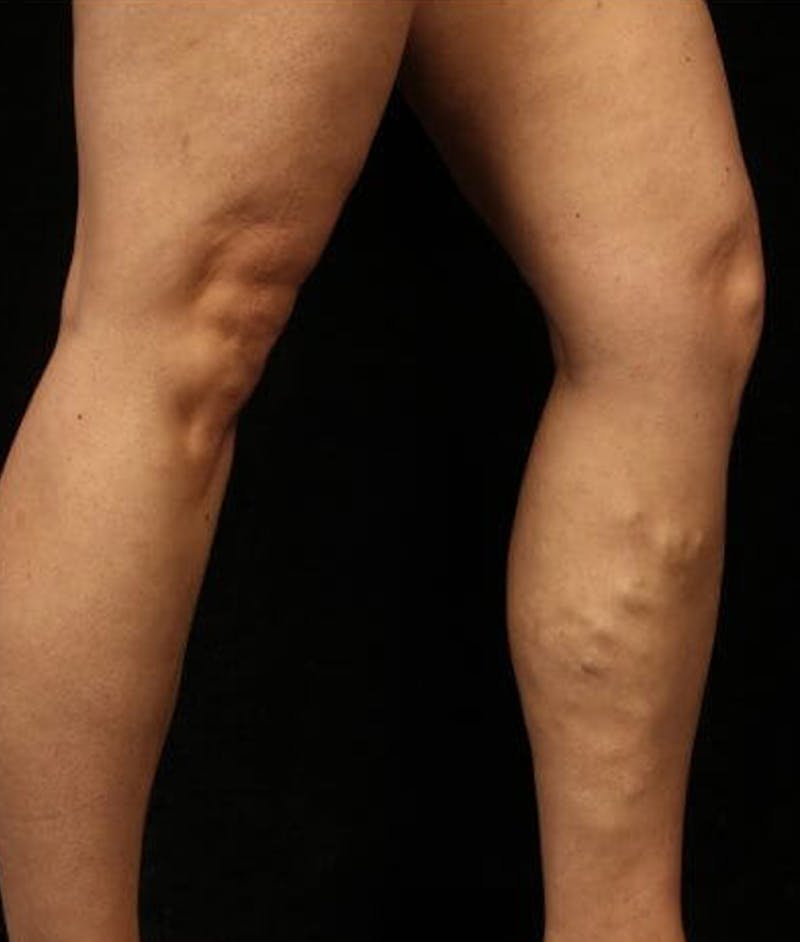 Varicose Veins Before & After Gallery - Patient 37499835 - Image 1