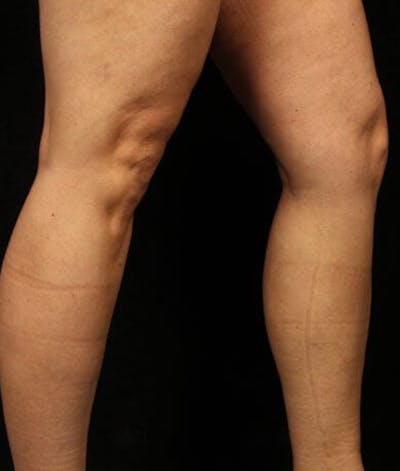 Varicose Veins Before & After Gallery - Patient 37499835 - Image 2