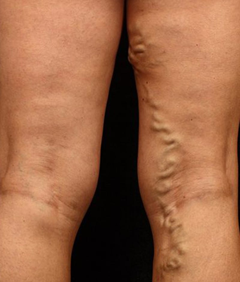 Varicose Veins Before & After Gallery - Patient 37499836 - Image 1