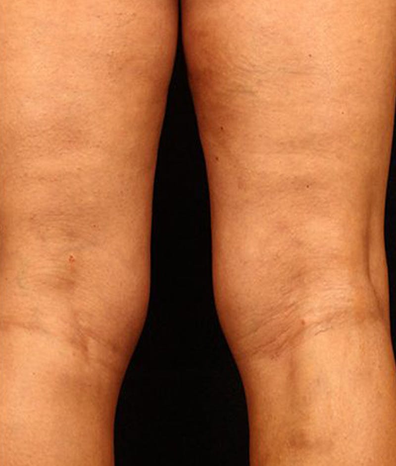 Varicose Veins Before & After Gallery - Patient 37499836 - Image 2