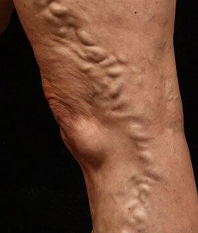 Varicose Veins Before & After Gallery - Patient 37499838 - Image 1