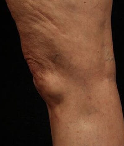 Varicose Veins Before & After Gallery - Patient 37499838 - Image 2