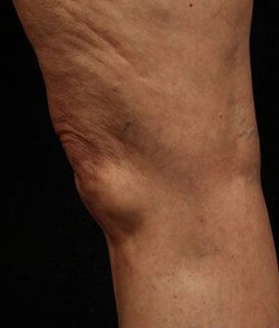 Varicose Veins Before & After Gallery - Patient 37499838 - Image 2