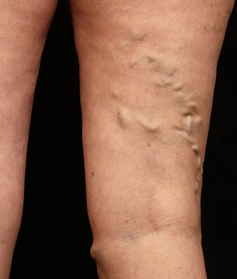 Varicose Veins Before & After Gallery - Patient 37499839 - Image 1