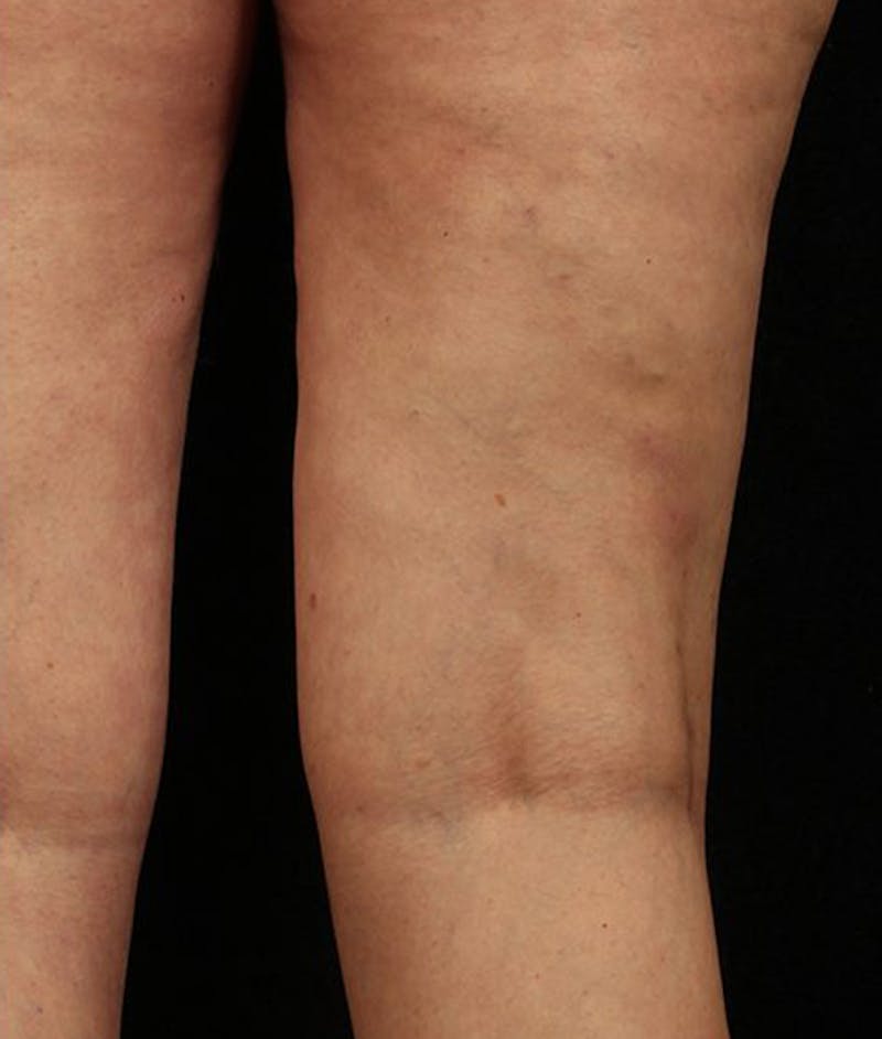 Varicose Veins Before & After Gallery - Patient 37499839 - Image 2