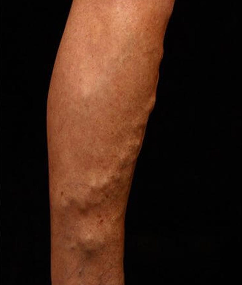 Varicose Veins Before & After Gallery - Patient 37499840 - Image 1