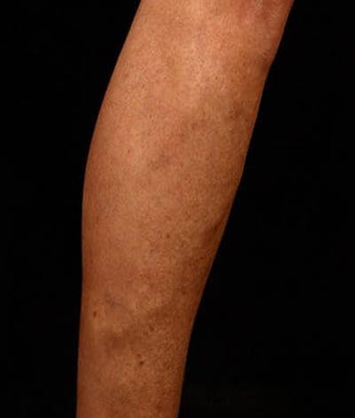 Varicose Veins Before & After Gallery - Patient 37499840 - Image 2