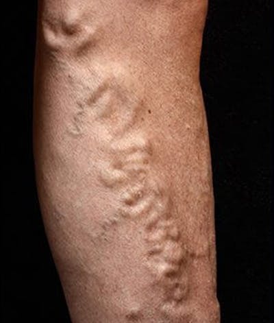 Varicose Veins Before & After Gallery - Patient 37499841 - Image 1