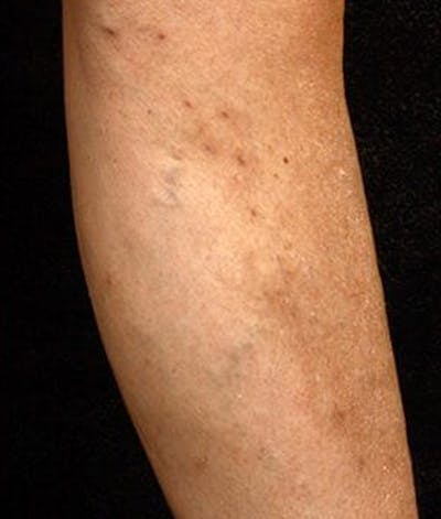 Varicose Veins Before & After Gallery - Patient 37499841 - Image 2