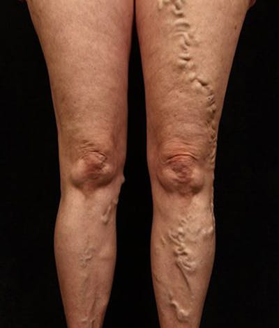 Varicose Veins Before & After Gallery - Patient 37499842 - Image 1