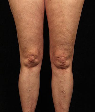 Varicose Veins Before & After Gallery - Patient 37499842 - Image 2