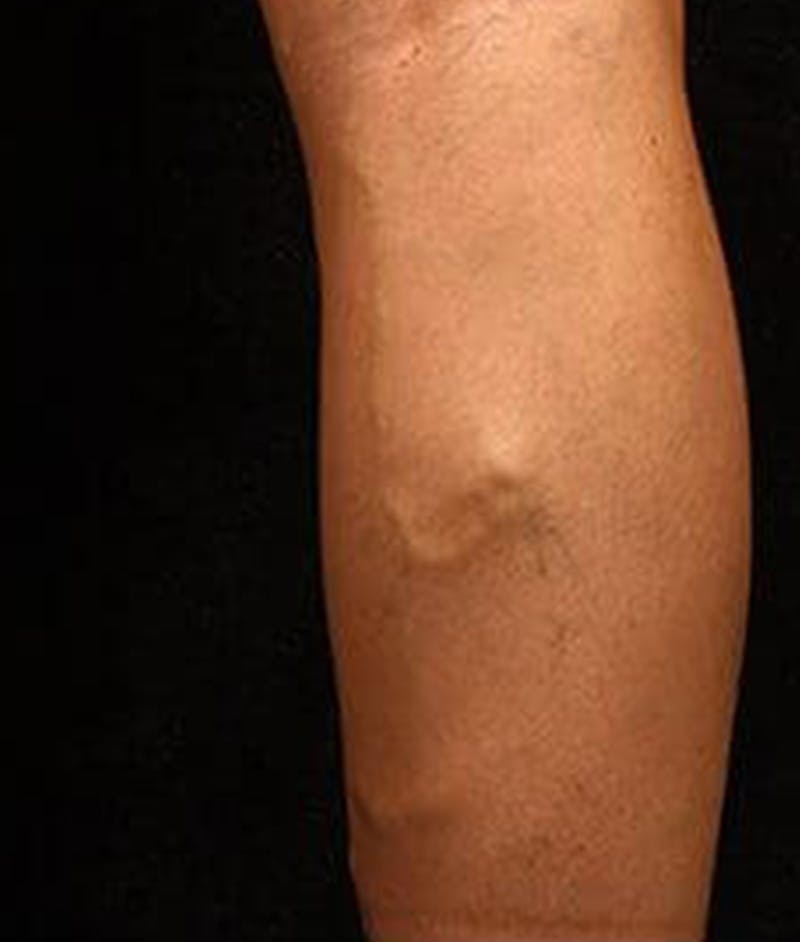 Varicose Veins Before & After Gallery - Patient 37499843 - Image 1