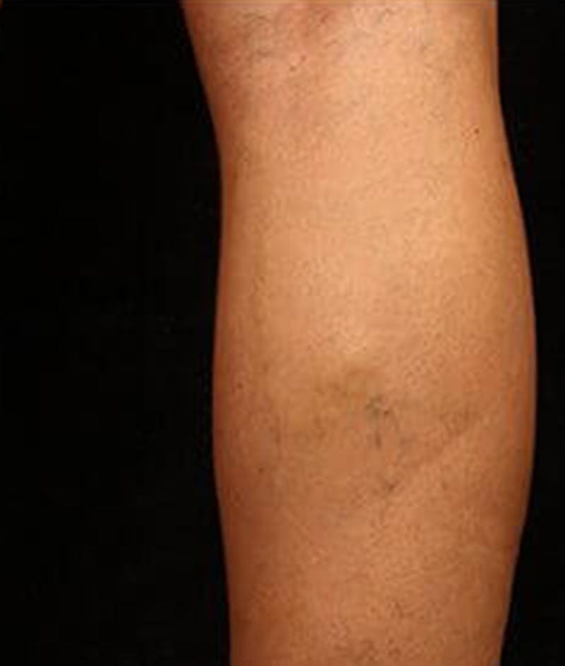 Varicose Veins Before & After Gallery - Patient 37499843 - Image 2