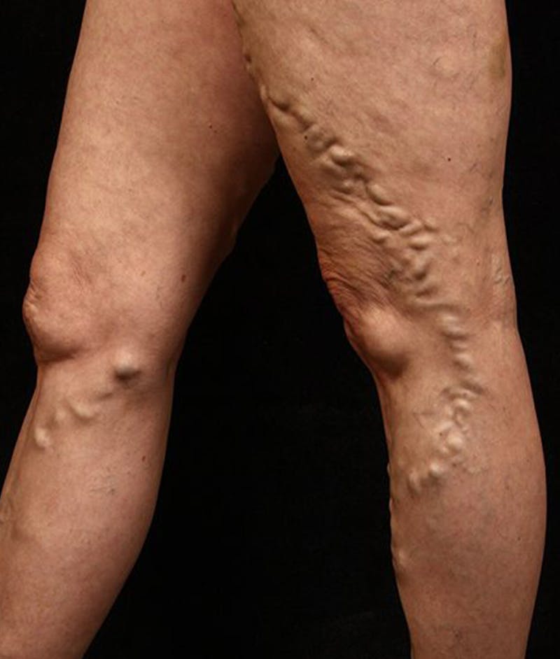 Varicose Veins Before & After Gallery - Patient 37499844 - Image 1