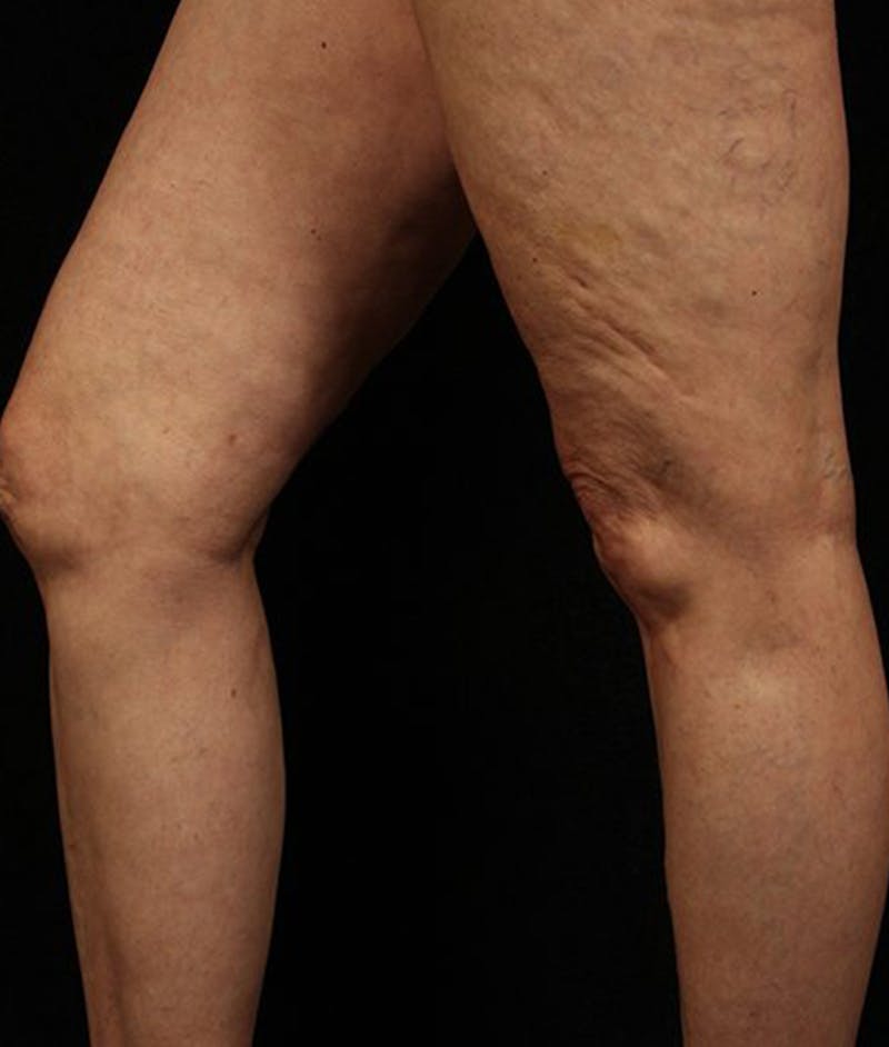 Varicose Veins Before & After Gallery - Patient 37499844 - Image 2