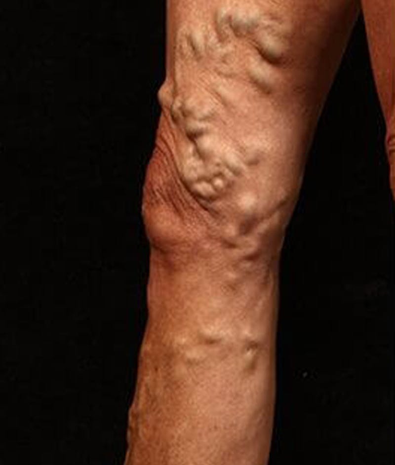 Varicose Veins Before & After Gallery - Patient 37499845 - Image 1