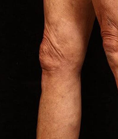 Varicose Veins Before & After Gallery - Patient 37499845 - Image 2