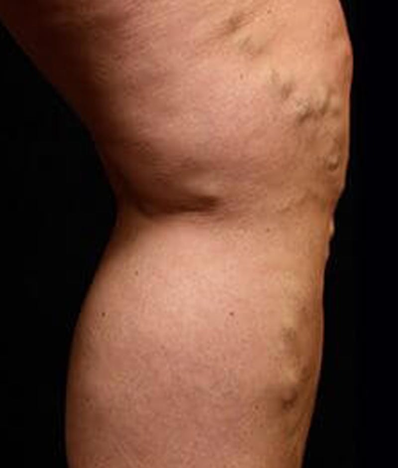 Varicose Veins Before & After Gallery - Patient 37499846 - Image 1