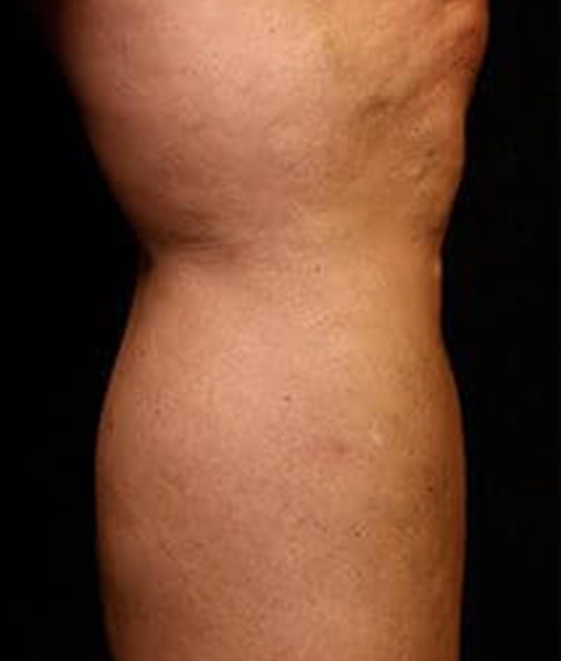 Varicose Veins Before & After Gallery - Patient 37499846 - Image 2