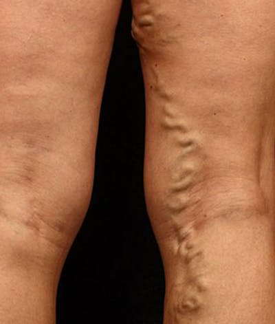 Varicose Veins Before & After Gallery - Patient 37499847 - Image 1