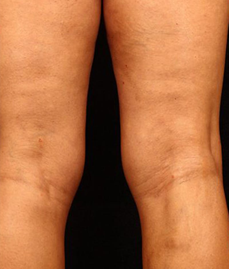 Varicose Veins Before & After Gallery - Patient 37499847 - Image 2