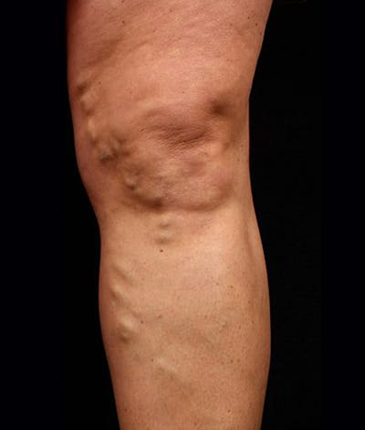 Varicose Veins Before & After Gallery - Patient 37499848 - Image 1