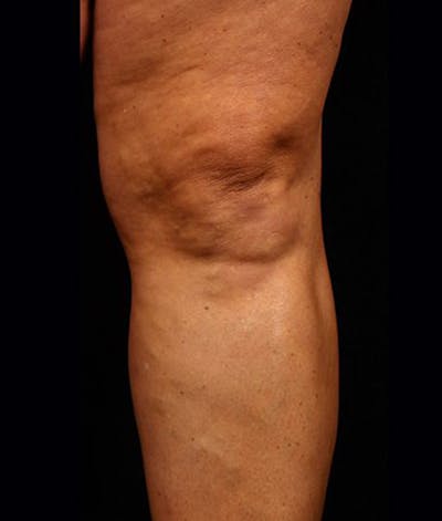 Varicose Veins Before & After Gallery - Patient 37499848 - Image 2