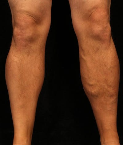 Endovenous Laser Therapy Before & After Gallery - Patient 37499426 - Image 1