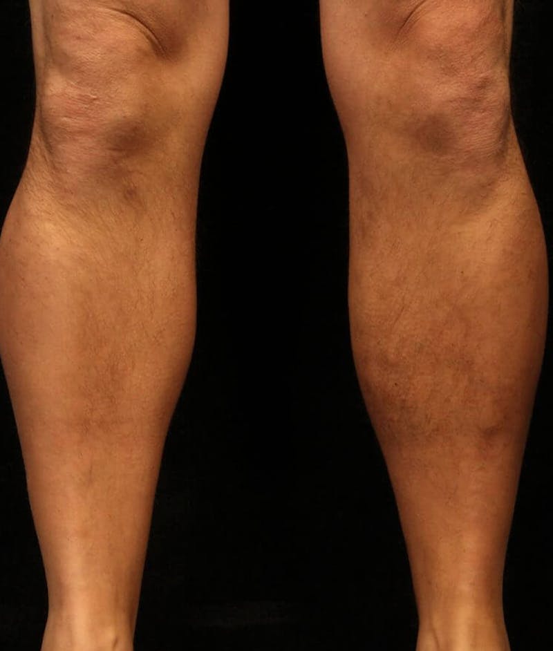 Endovenous Laser Therapy Before & After Gallery - Patient 37499426 - Image 2