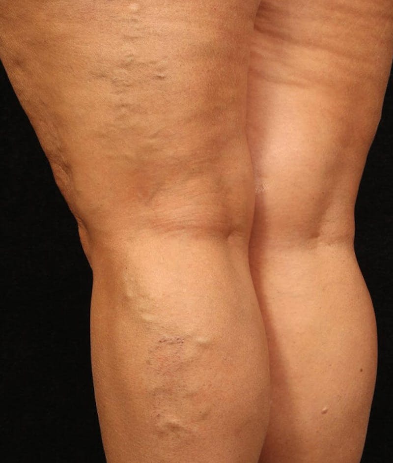 Endovenous Laser Therapy Before & After Gallery - Patient 37499439 - Image 1