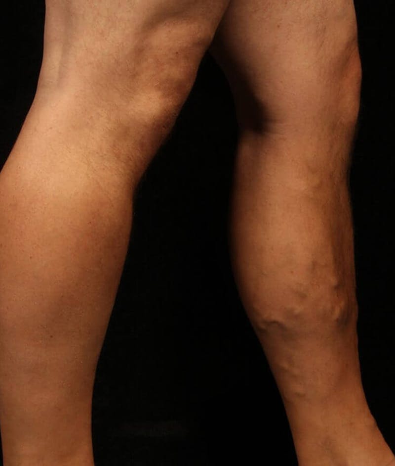 Endovenous Laser Therapy Before & After Gallery - Patient 37499430 - Image 1