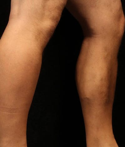 Endovenous Laser Therapy Before & After Gallery - Patient 37499430 - Image 2