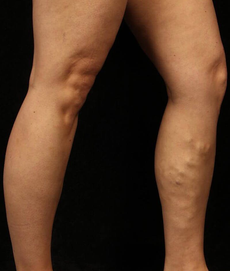 Endovenous Laser Therapy Before & After Gallery - Patient 37499444 - Image 1