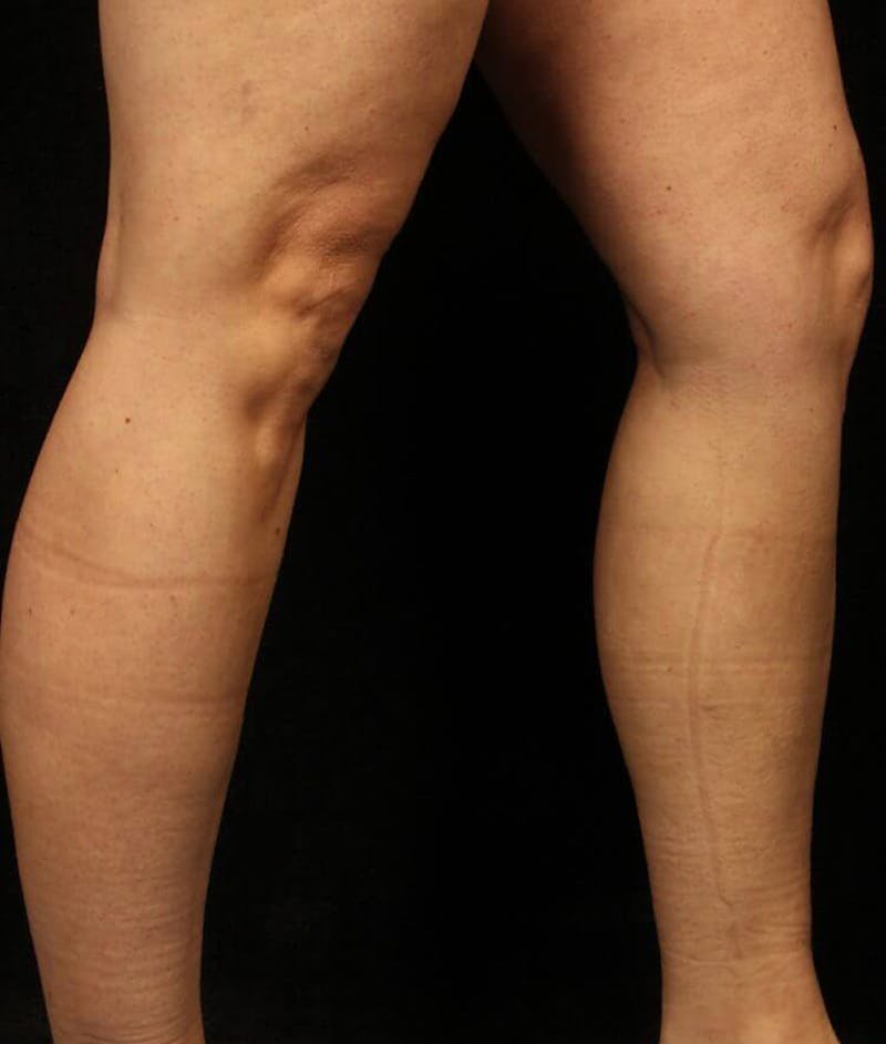 Endovenous Laser Therapy Before & After Gallery - Patient 37499444 - Image 2