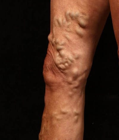 Endovenous Laser Therapy Before & After Gallery - Patient 37499449 - Image 1