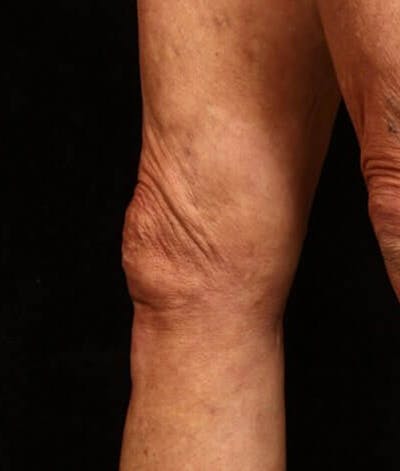 Endovenous Laser Therapy Before & After Gallery - Patient 37499449 - Image 2
