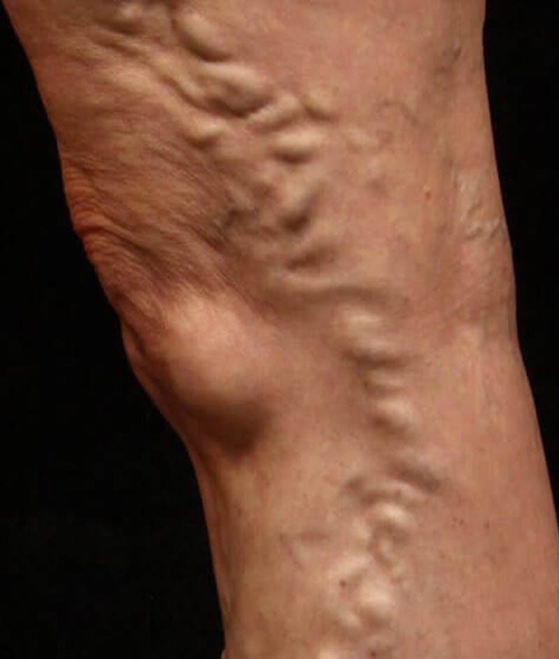Endovenous Laser Therapy Before & After Gallery - Patient 37499457 - Image 1