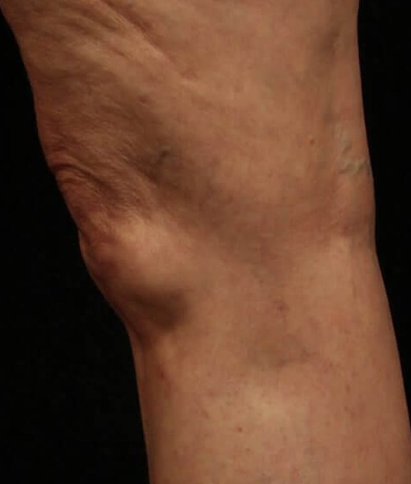 Endovenous Laser Therapy Before & After Gallery - Patient 37499457 - Image 2