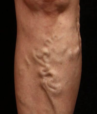 Endovenous Laser Therapy Before & After Gallery - Patient 37499462 - Image 1