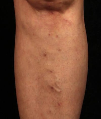 Endovenous Laser Therapy Before & After Gallery - Patient 37499462 - Image 2